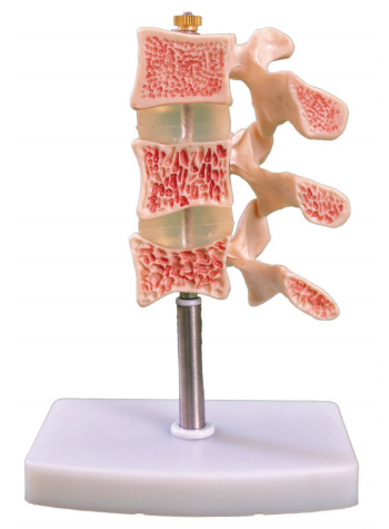 脊椎典型病变模型