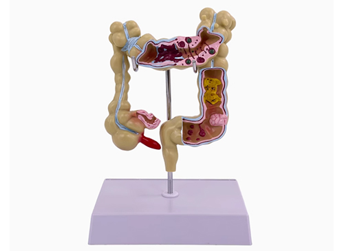 大肠病变模型
